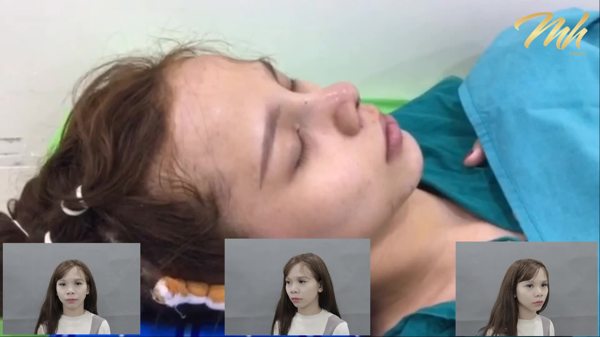 Nâng mũi cấu trúc - Thẩm mỹ viện MH Beauty - Ca 06