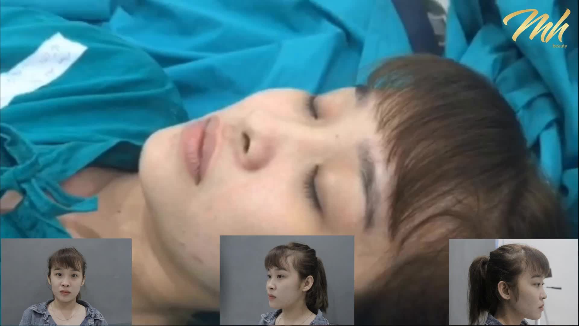 Nâng mũi cấu trúc - Thẩm mỹ viện MH Beauty - Ca 07