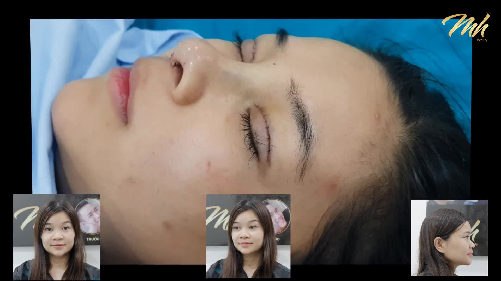 Nâng mũi cấu trúc - Thẩm mỹ viện MH Beauty - Ca 04