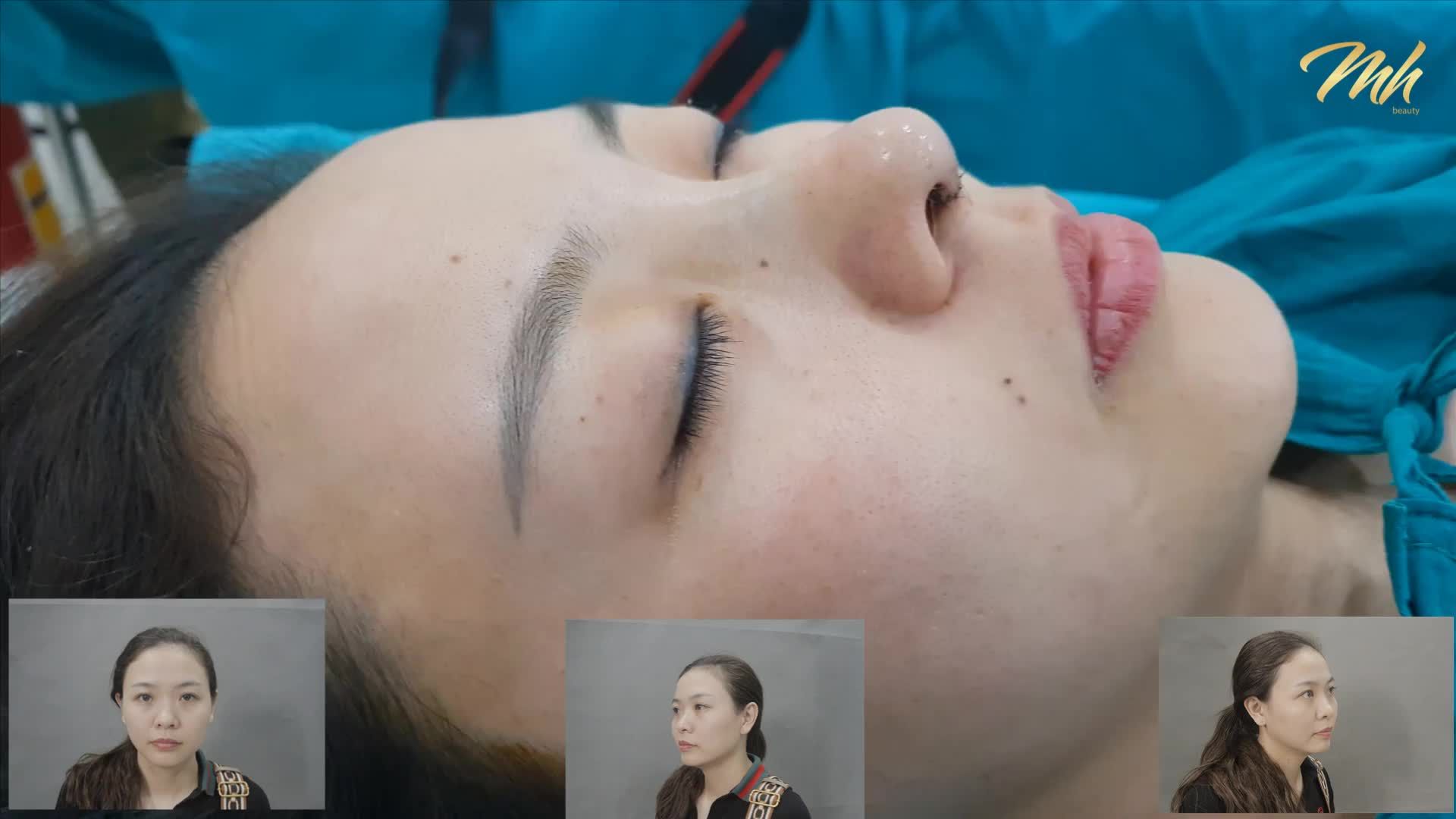 Nâng mũi - Thẩm mỹ viện MH Beauty - Ca 08