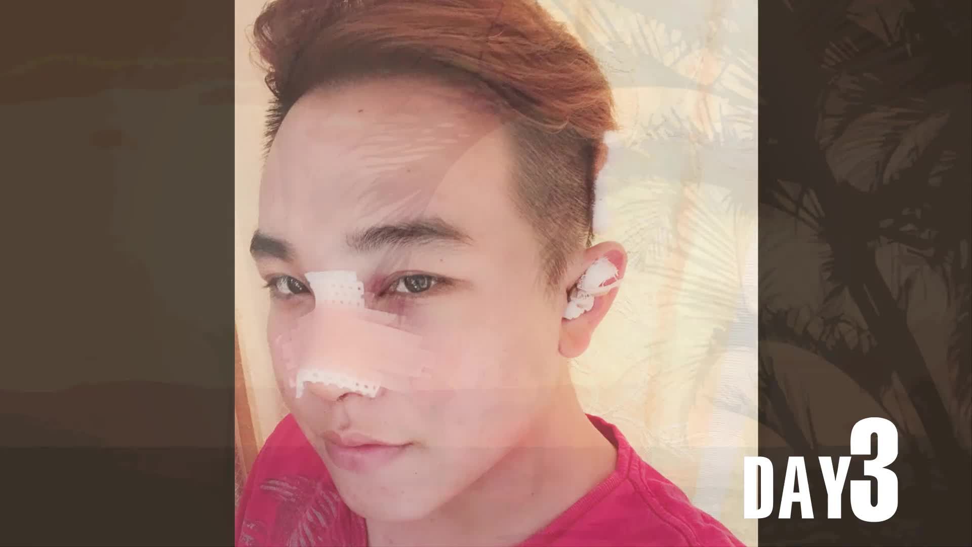 Nâng mũi - Bác sĩ Mã Hiệp - Ca 36