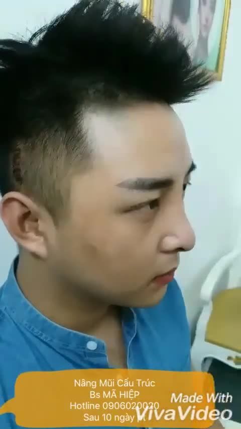 Nâng mũi - Bác sĩ Mã Hiệp - Ca 67