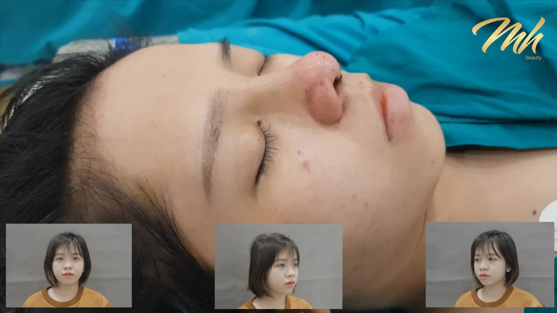 Nâng mũi cấu trúc - Thẩm mỹ viện MH Beauty - Ca 03