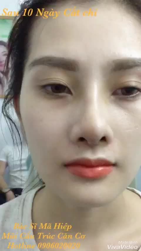 Nâng mũi cấu trúc - Bác sĩ Mã Hiệp - Ca 38