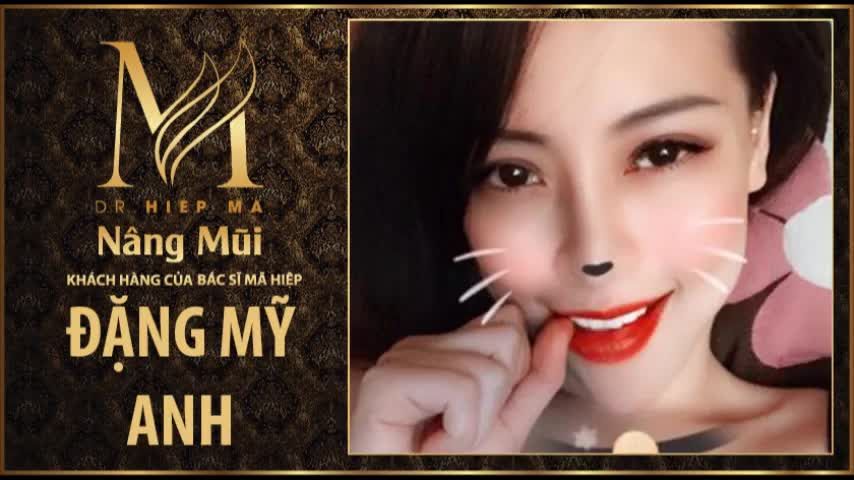 Nâng mũi - Bác sĩ Mã Hiệp - Ca 63