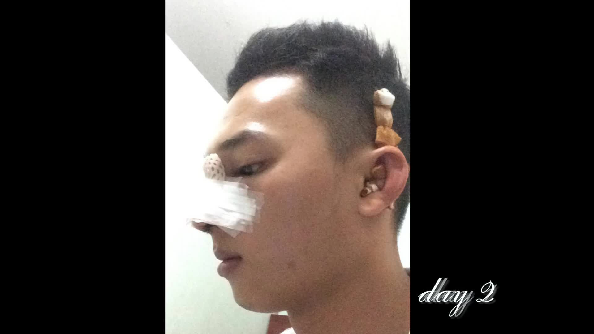 Nâng mũi - Bác sĩ Mã Hiệp - Ca 37