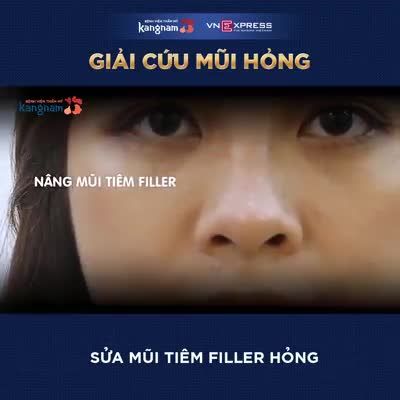 Giải cứu mũi hỏng - Thẩm mỹ Kangnam - Ca 36