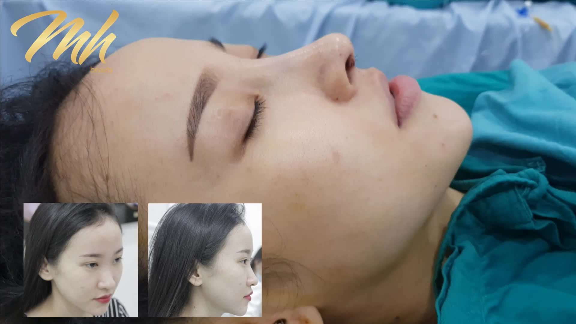 Nâng mũi - Thẩm mỹ viện MH Beauty – Ca 13