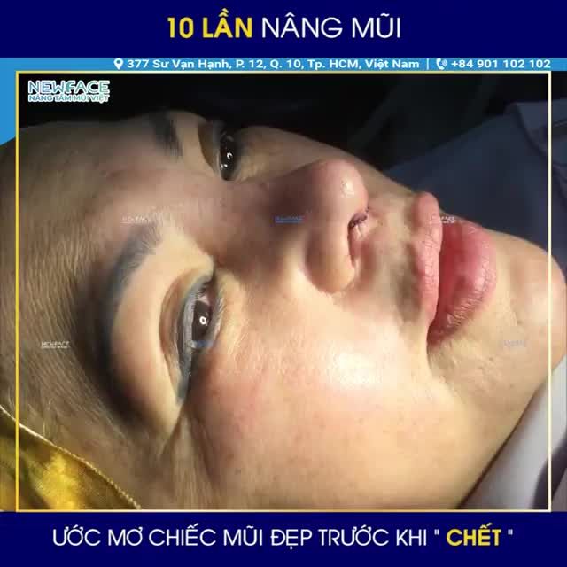 Câu chuyện nâng mũi 1: Cô khách việt Kiều Mỹ 70 tuổi thỏa ước nguyện chiếc mũi đẹp trước khi chết