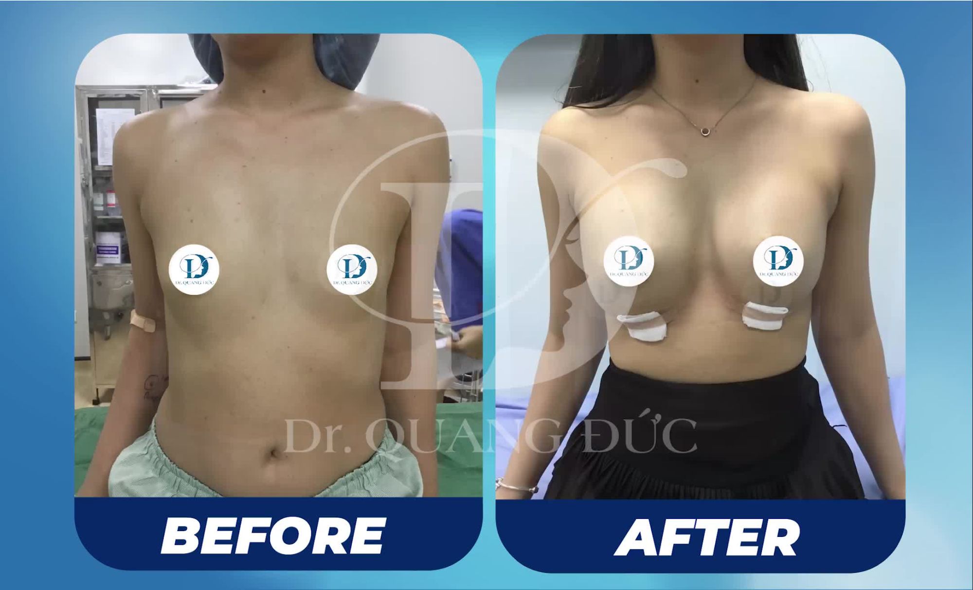 Chiêm ngưỡng kết quả trước sau nâng ngực - Dr Quang Đức