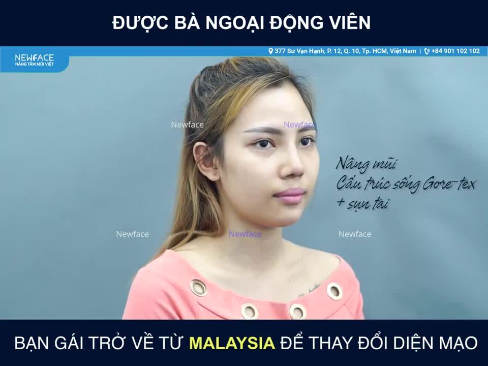 Bạn gái đến từ Malaysia tự tin hơn chỉ sau 14 ngày NÂNG MŨI và ĐỘN CẰM - Bs Trần Phương
