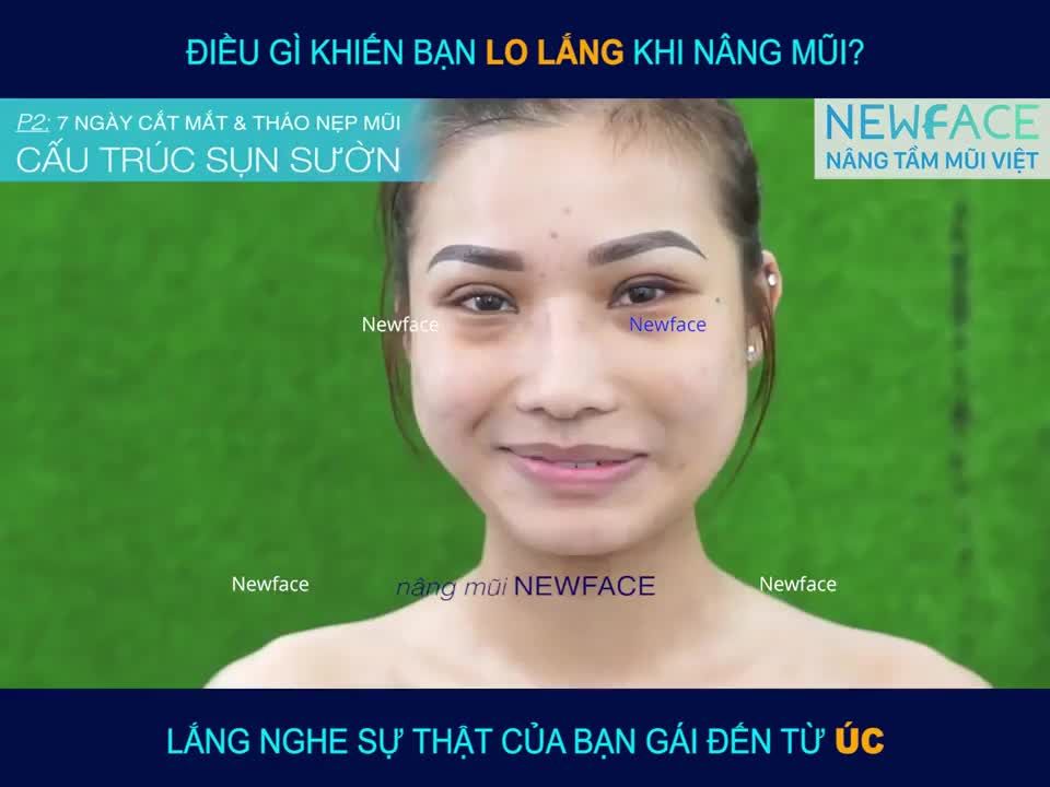 Điều gì khiến bạn lo lắng khi nâng mũi - Bs Trần Phương