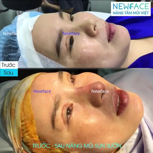 Hình ảnh trước và ngay sau phẫu thuật nâng mũi cấu trúc sụn sườn thực hiện tại bệnh viện - Bs Trần Phương