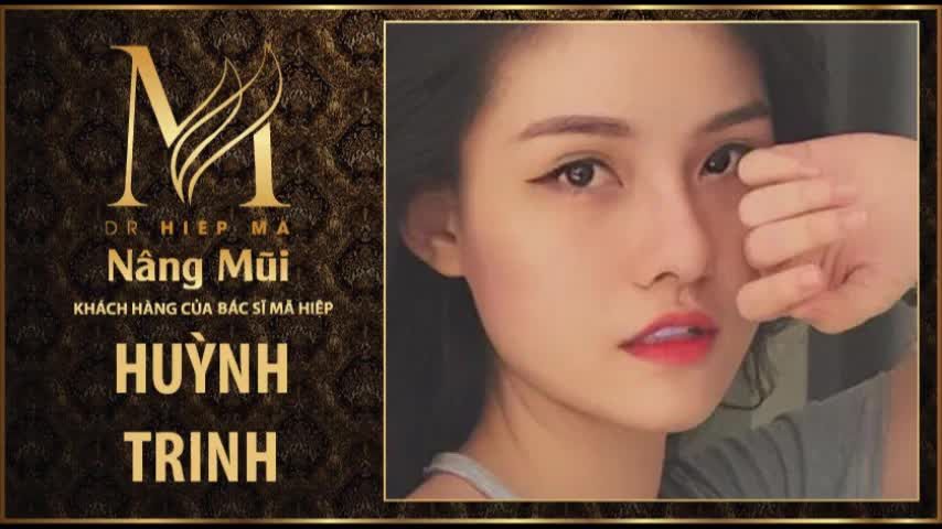 Nâng mũi - Bác sĩ Mã Hiệp - Ca 47