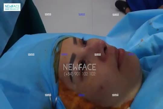 Kết quả ngay sau nâng mũi sụn sườn - Bs Trần Phương