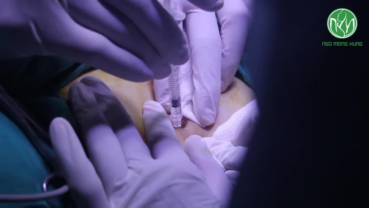Phẫu thuật tạo hình núm vú tụt - Bs Ngô Mộng Hùng