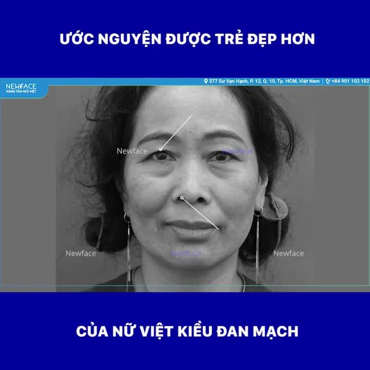BAY TỪ ĐAN MẠCH VỀ VIỆT NAM NÂNG MŨI + CẮT MÍ - Bs Trần Phương
