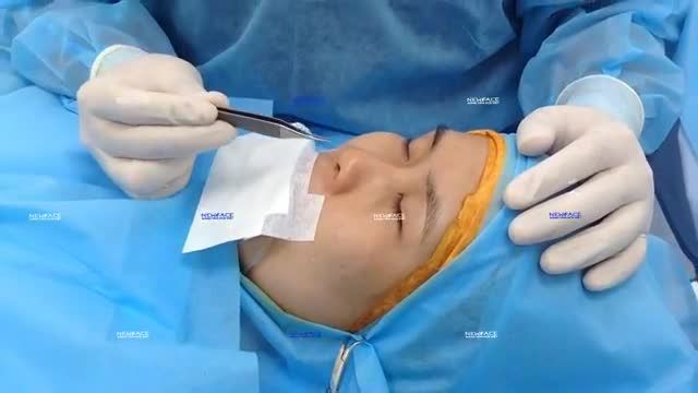 PHÂN VÂN CHƯA BIẾT SỬ DỤNG VẬT LIỆU NÂNG MŨI NÀO CHO PHÙ HỢP???