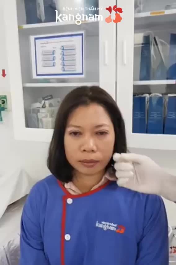 Chọn BẤM MÍ hay CẮT MÍ khi bạn muốn có đôi mắt 2 mí bây giờ?