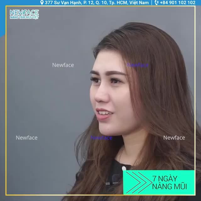 BẠN CHI SAU 7 NGÀY NÂNG MŨI CẤU TRÚC SỤN SƯỜN