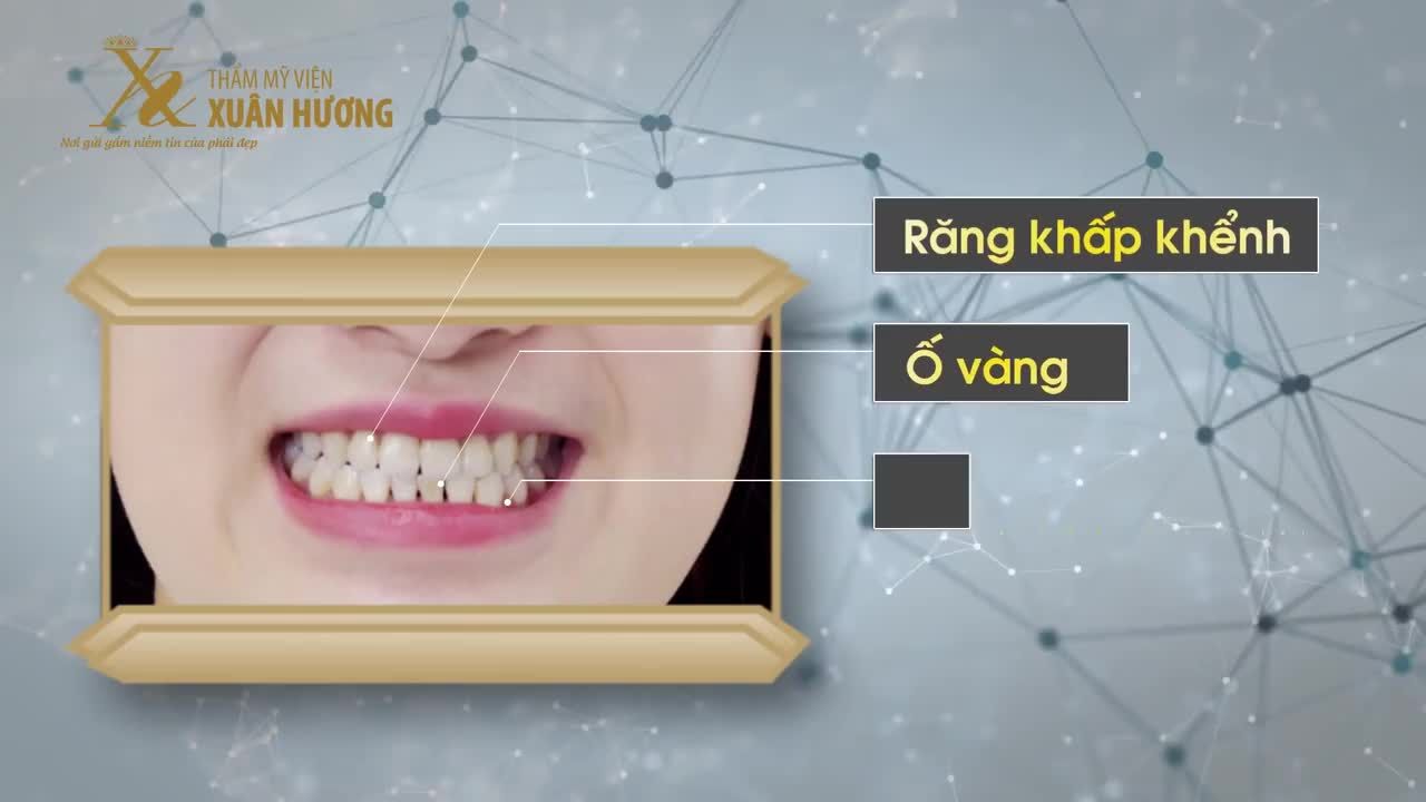 Á QUÂN THE VOICE - CA SĨ MINH NGỌC HOÀN TOÀN HÀI_LÒNG VỚI PHỦ_RĂNG_SỨ CAD CAM 3D