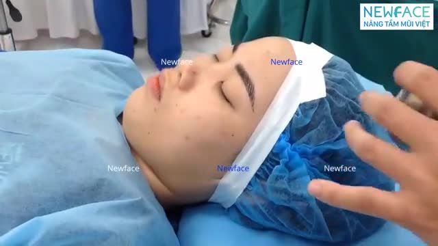 NÂNG MŨI CẤU TRÚC SỐNG MŨI GORE-TEX. CẬN CẢNH TOÀN BỘ QUÁ TRÌNH PHẪU THUẬT