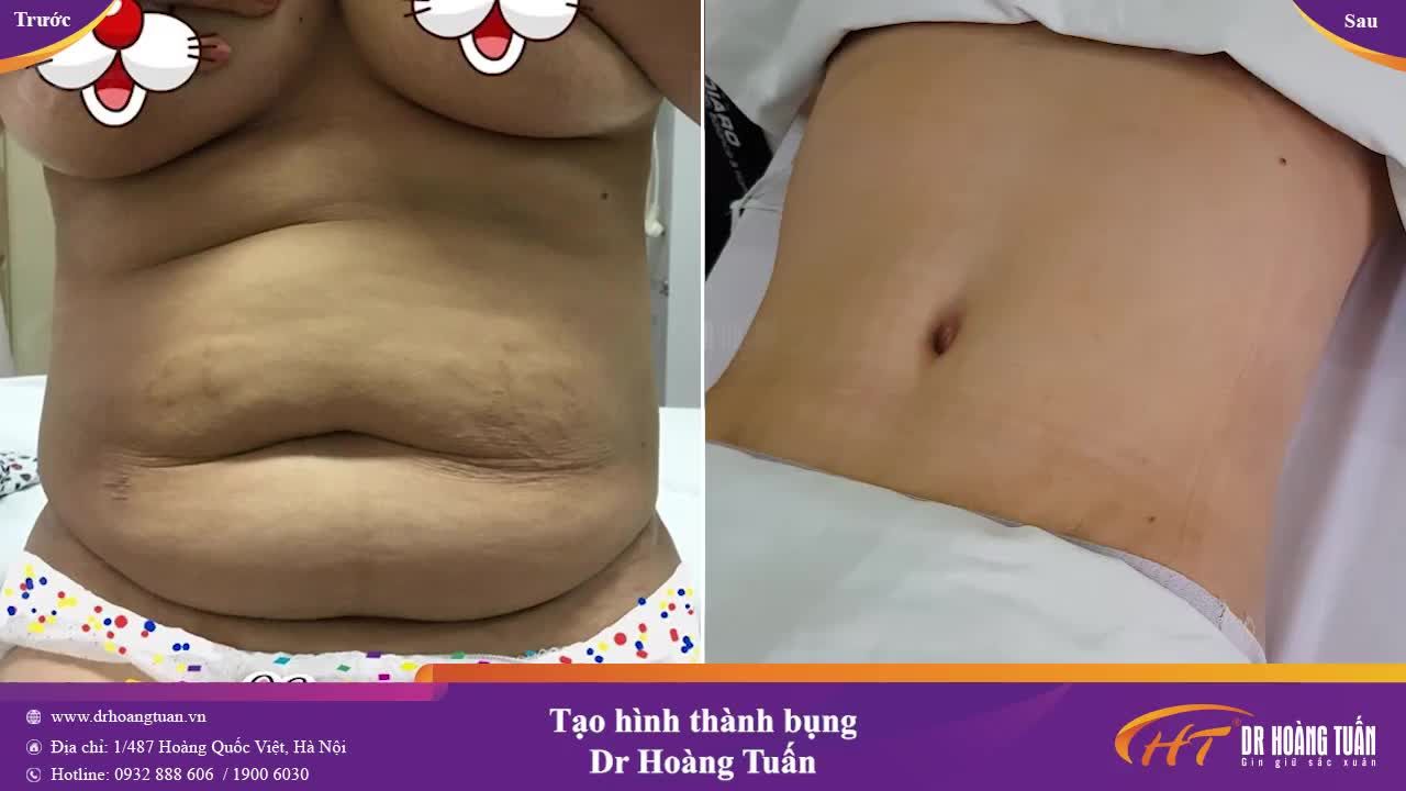Chiêm ngưỡng từng góc quay với vòng bụng sau 1 tháng phẫu thuật