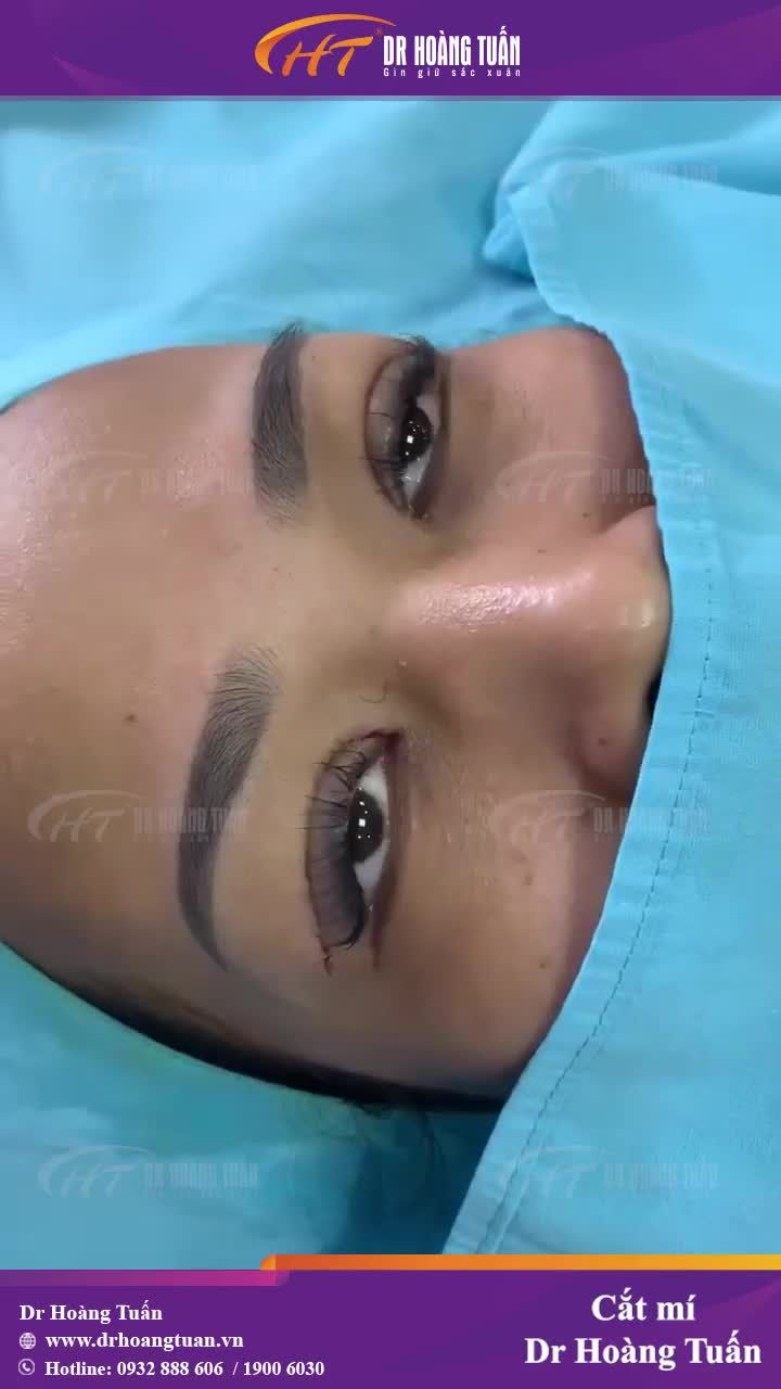 Cắt mí Dr Hoàng Tuấn - cho bạn đôi mắt tươi trẻ chỉ sau 30 phút!
