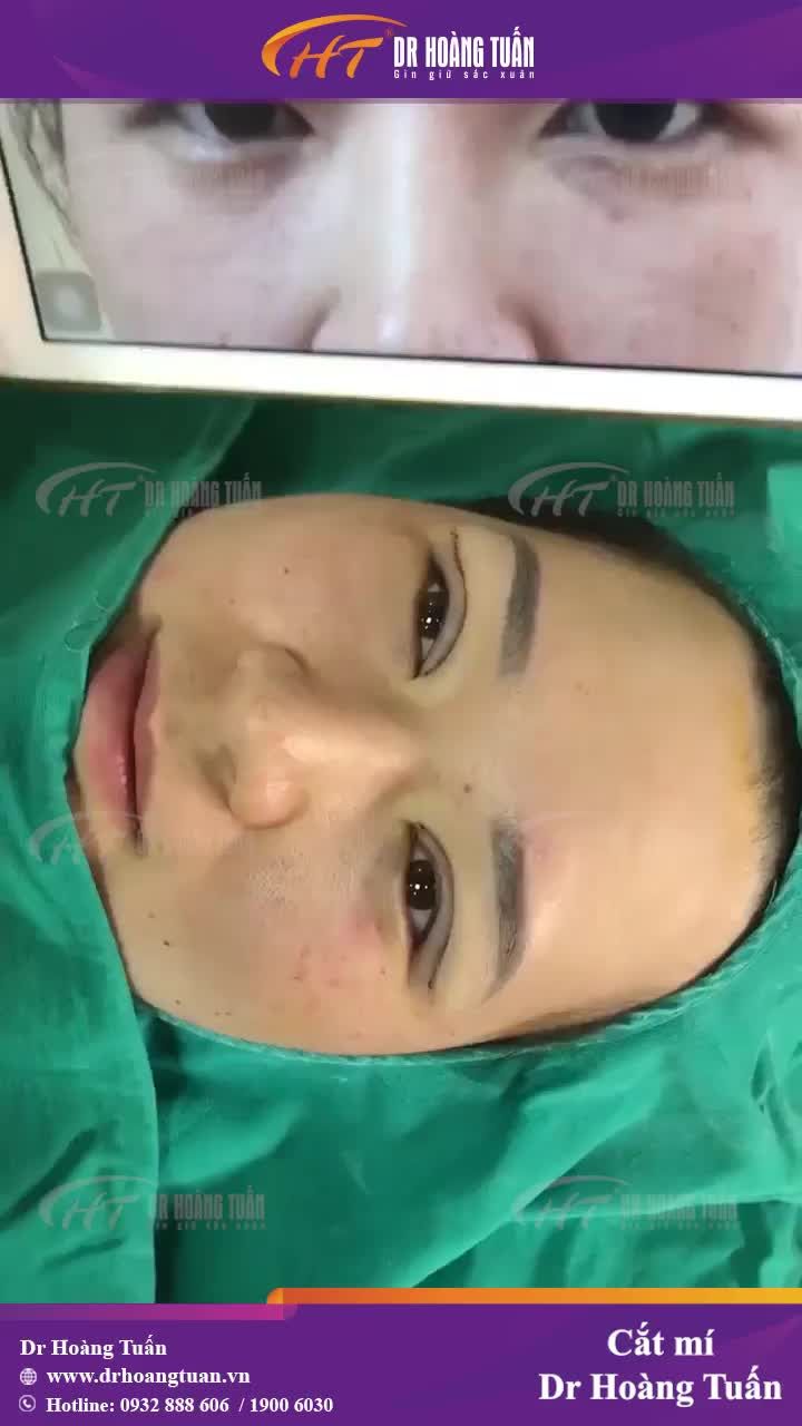 Đôi mắt có hồn, tươi tắn hơn chỉ sau 30 phút cắt mí tại Dr Hoàng Tuấn!