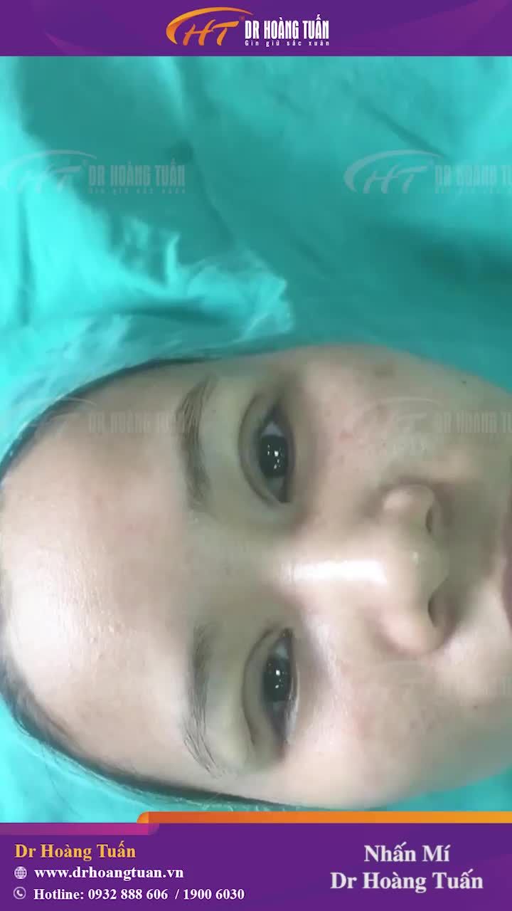 Đôi mắt lệch mí và phương pháp khắc phục!