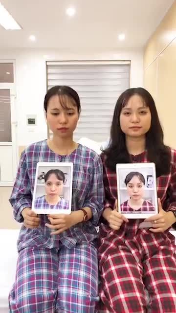 Mắt lờ đờ, nhiều nếp mí phụ và sự lột xác ngay sau nhấn mí