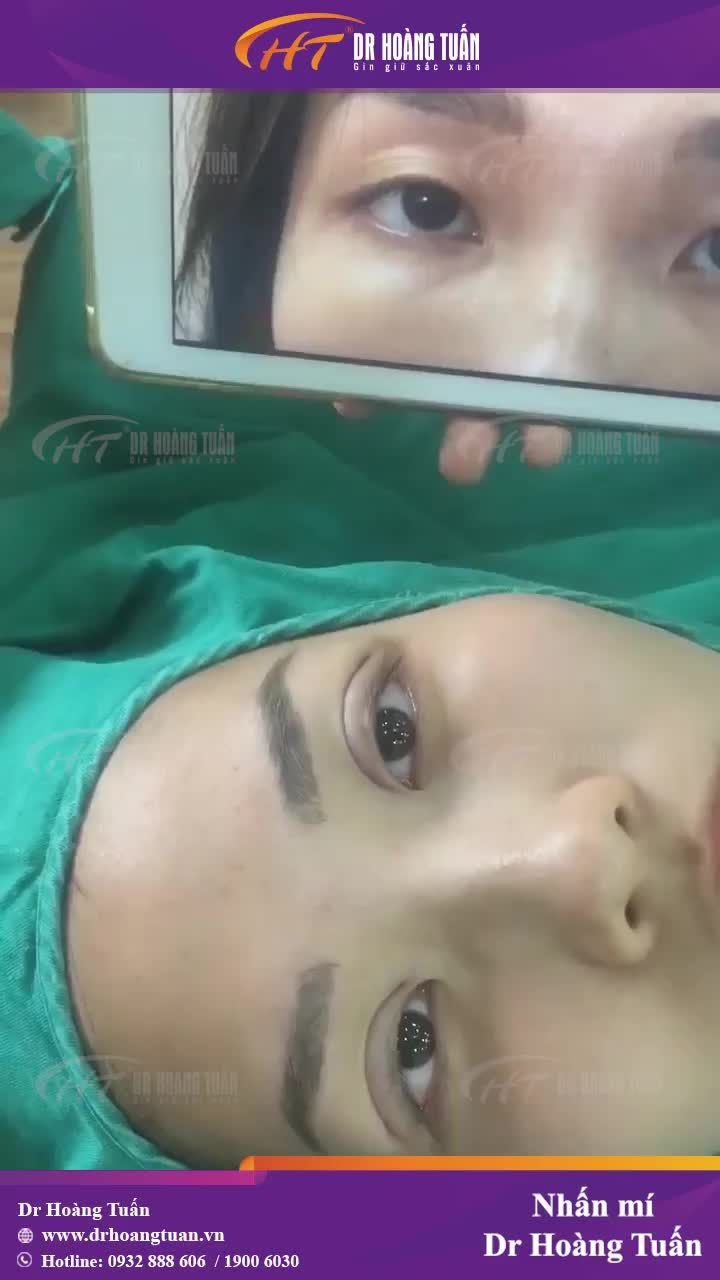 Tìm lại đôi mắt huyền cho bạn gái chỉ sau 10 phút nhấn mí tại Dr Hoàng Tuấn!