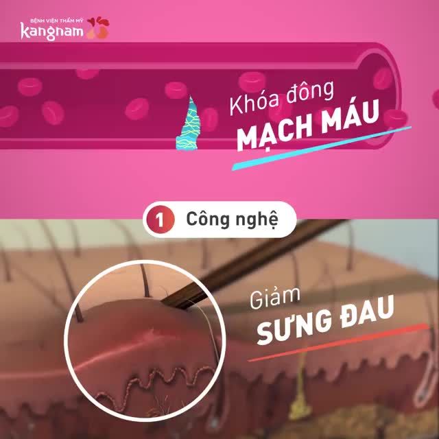 SẸO CẮT MÍ - Trông như thế nào❓