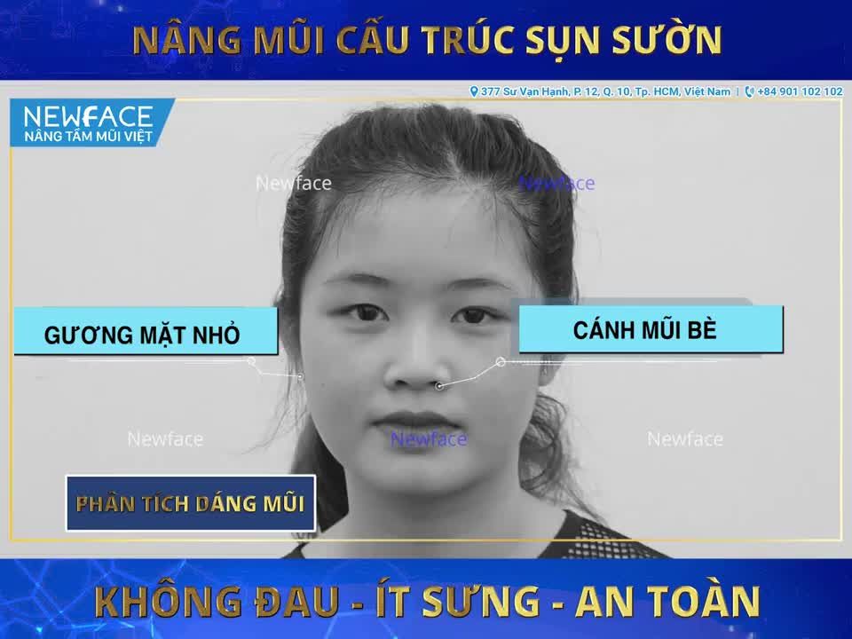 CÂU CHUYỆN NÂNG MŨI CỦA THANH THÙY (PHẦN 3)