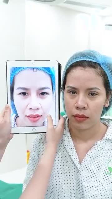 Cùng chiêm ngưỡng kết quả của chị Kh sau 15' thực hiện Cắt mí Pro Mini/Open Deep P'Cell nhé.