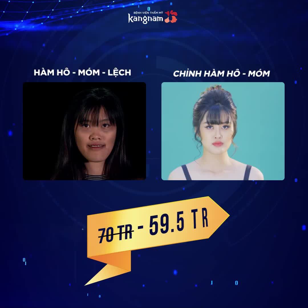 Chỉnh hình hàm mặt chỉ từ 12 triệu