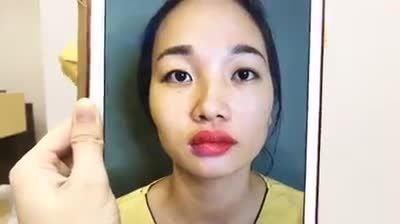 Chữa trị mắt sụp mí bằng phẫu thuật thẩm mỹ cắt mí Mani Open Deep 5D