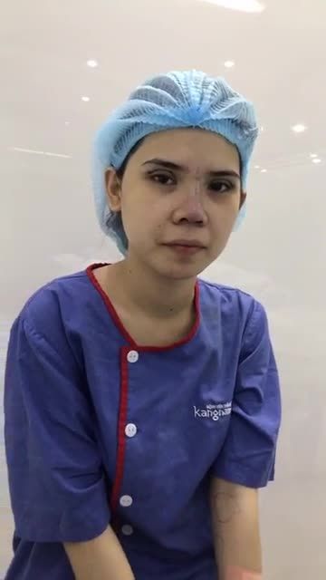 Kết quả sau combo nâng mũi cấu trúc 4D + cắt mí trên plasma