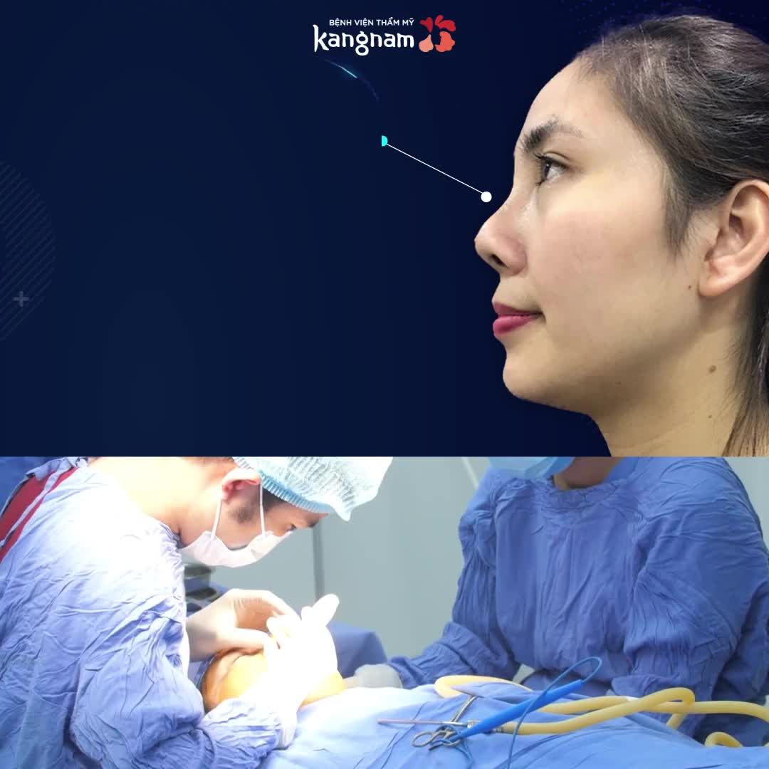Bạn đã cập nhật công nghệ nâng mũi mới nhất chưa?