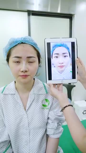 Dáng mũi đã được cải thiện rõ rệt chỉ sau 15' thực hiện Nâng mũi High Line