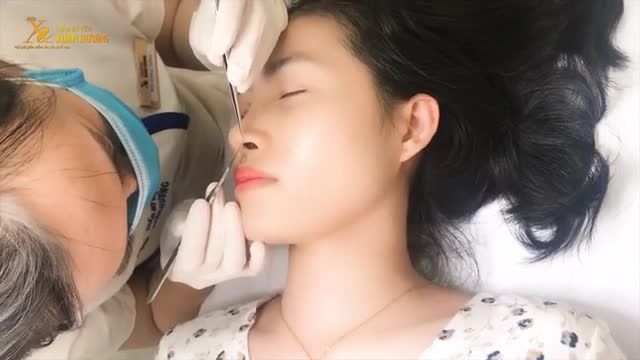 DÁNG MŨI XẤU ẢNH HƯỞNG ĐẾN CẢ KHUÔN MẶT, SAU 10 NGÀY KHÁCH HÀNG "LỘT XÁC" BẤT NGỜ