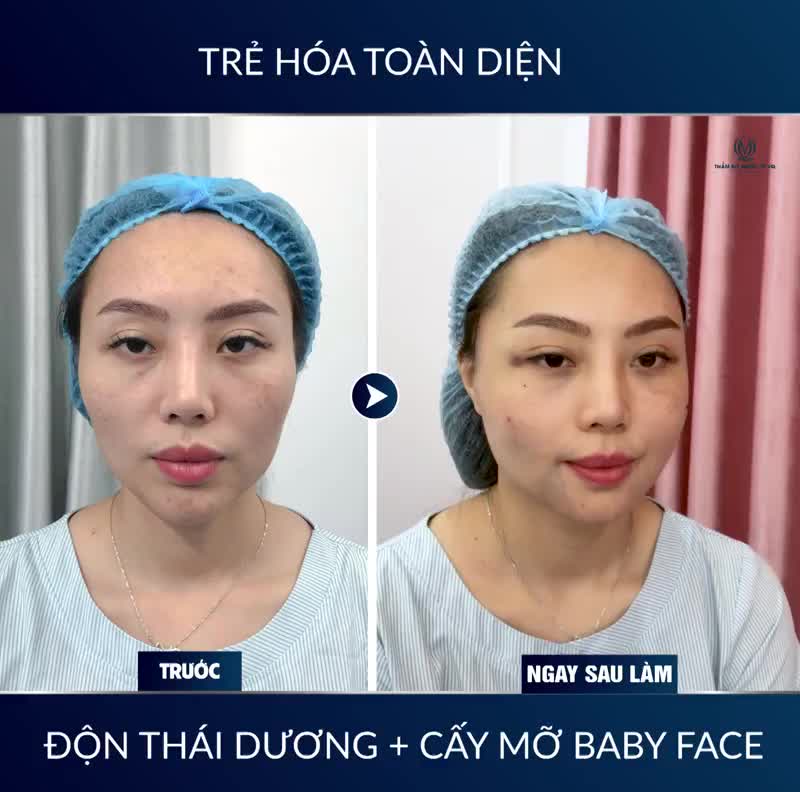 ĐẦY ĐẶN - TRẺ TRUNG - NGĂN LÃO HÓA Chỉ với 45 phút sau khi cấy mỡ BABY FACE bằng mỡ tự thân
