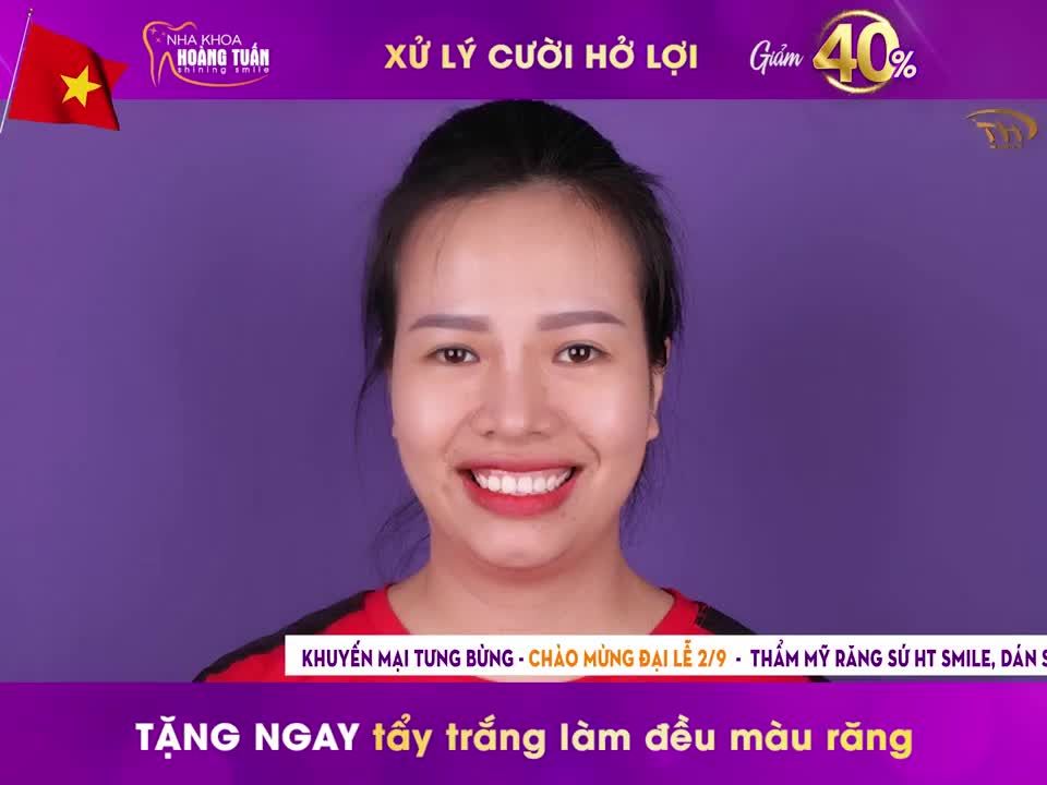 Điều trị cười hở lợi – Giải pháp cho nụ cười đẹp hoàn hảo