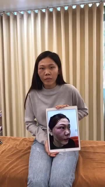 U máu của e đã thay đổi rõ rệt qua từng buổi điều trị bằng công nghệ Vbeam