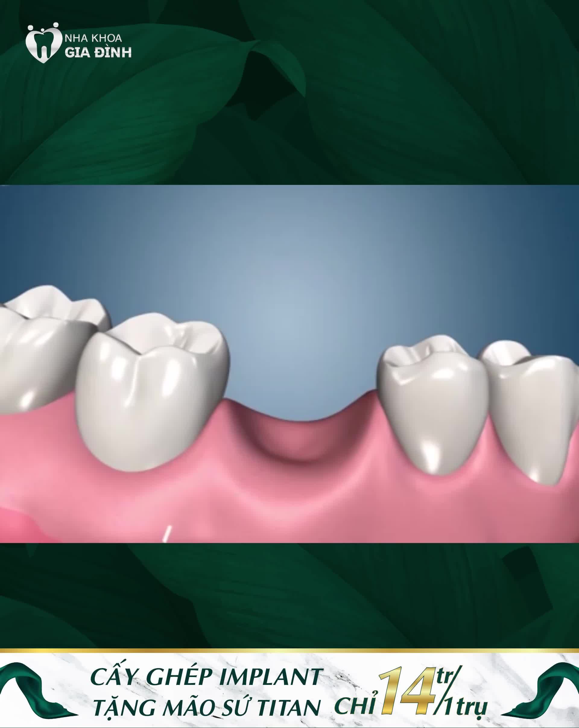 CẤY GHÉP IMPLANT CHỈ 14TR/TRỤ + TẶNG MÃO SỨ TITAN