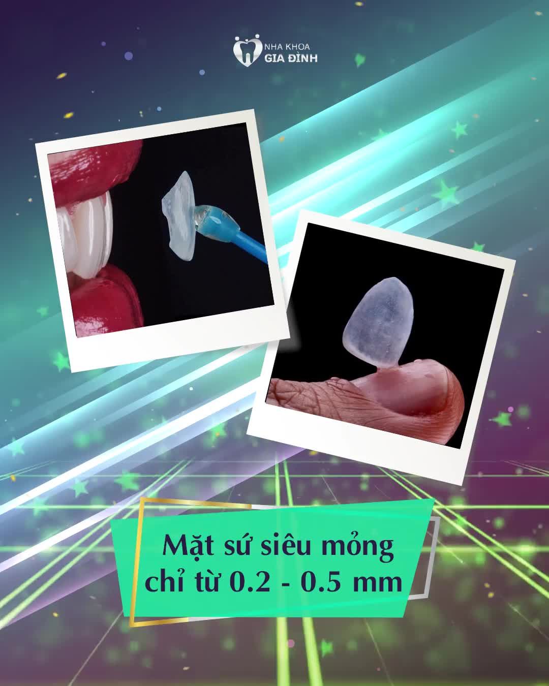 DÁN SỨ VENEER – GIẢI PHÁP CHO NỤ CƯỜI HOÀN HẢO