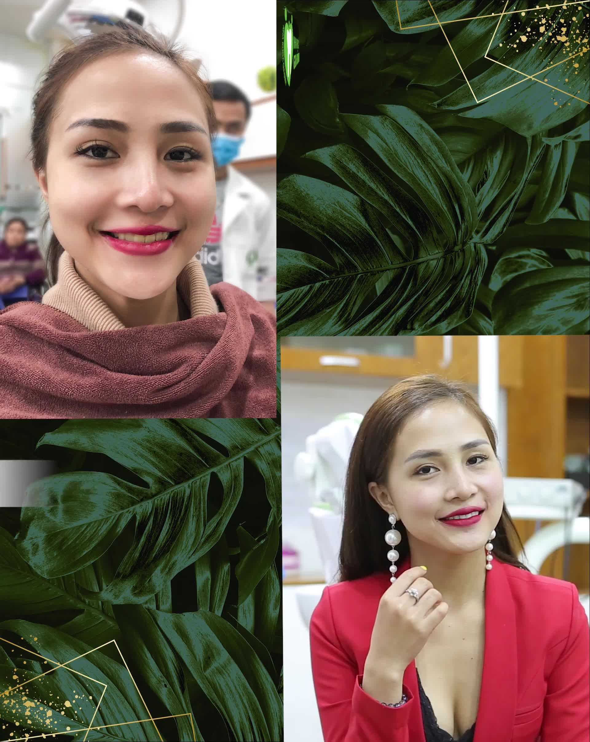 RĂNG SỨ CERAMILL – CHO NỤ CƯỜI ĐẸP HOÀN MỸ