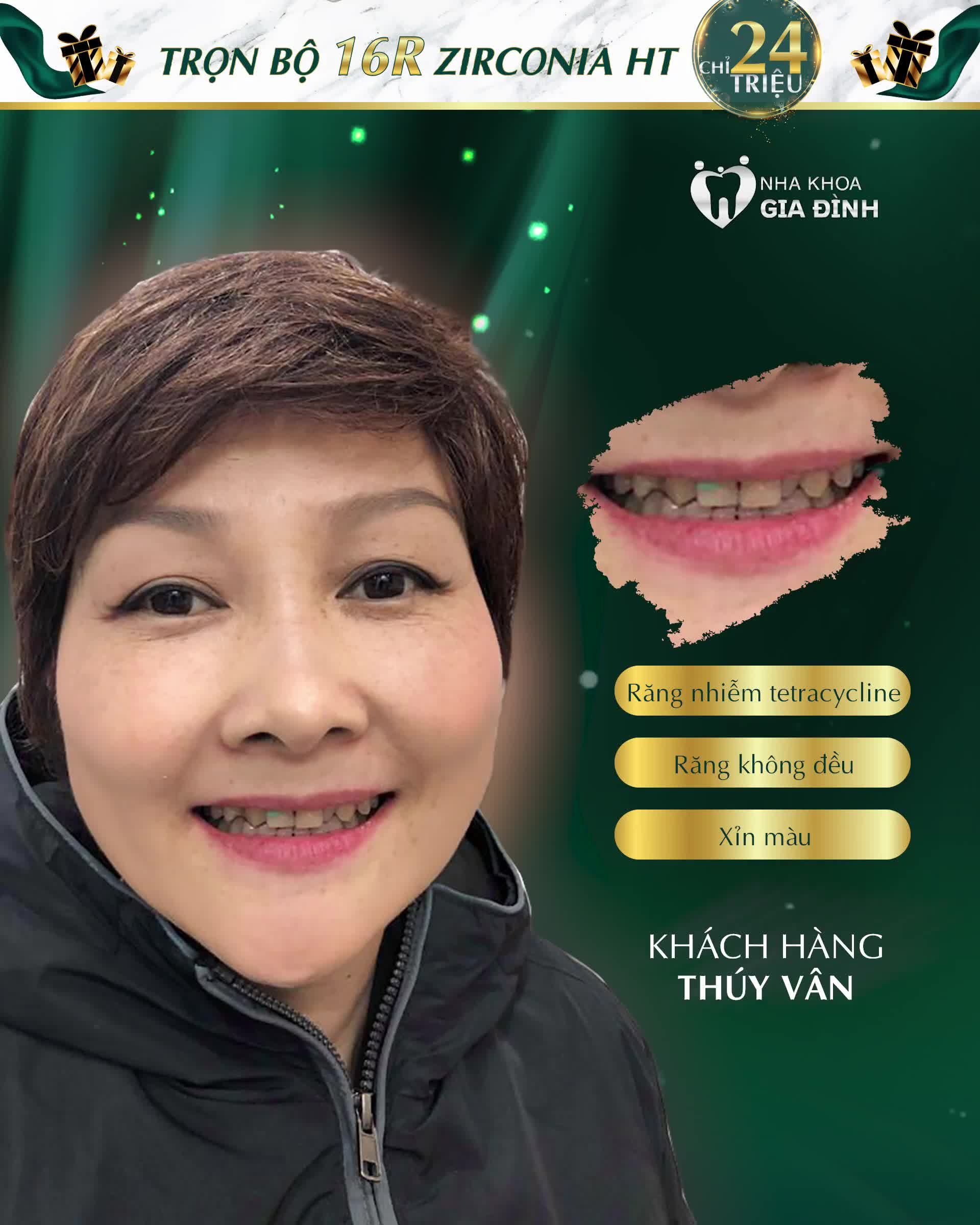 Sống ở Đức nhưng chị Thúy Vân lại quyết định về Việt Nam và đến Nha khoa Gia Đình để thẩm mỹ răng vì tin tưởng tuyệt đối vào tay nghề cũng như guu thẩm mỹ của bác sĩ tại đây.