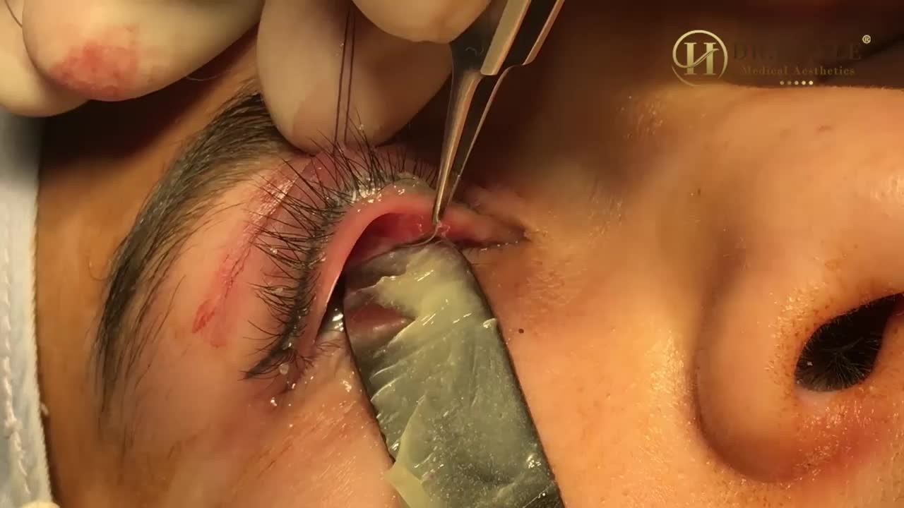 GÃY KIM TRONG MẮT KHI THẨM MỸ TẠI CƠ SỞ KHÔNG UY TÍN - MỖI HIỂM HỌA KHÔN LƯỜNG