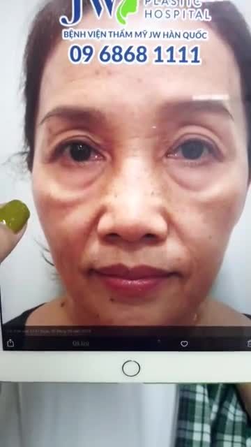 Hành trình giải cứu đôi mắt đượm buồn cho nữ khách hàng U60 đang trong thời kỳ lão hóa bằng phương pháp MID FACE 3 IN 1 độc quyền tại Bệnh viện JW